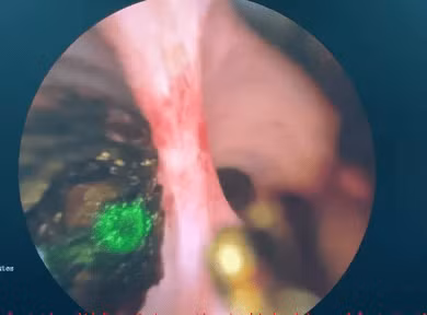 Hình ảnh tán sỏi qua đường hầm Kehr