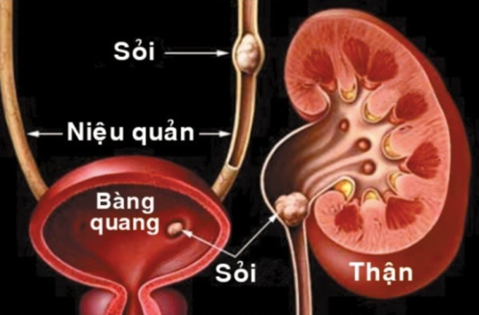 Sỏi tiết niệu gây nhiều biến chứng nếu không xử lý sớm. Ảnh: Bệnh viện cung cấp Sỏi tiết niệu gây nhiều biến chứng nếu không xử lý sớm. Ảnh: Bệnh viện cung cấp