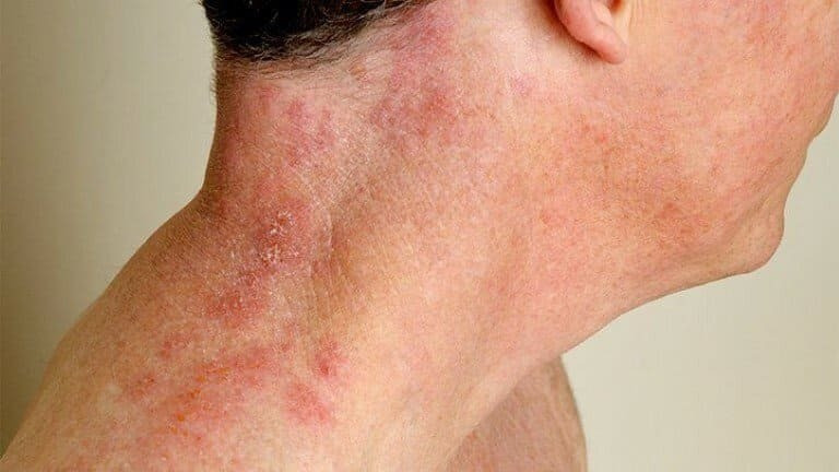 Ở người lớn tuổi do virus Varicella – Zoster tái hoạt động và tấn công vào các dây thần kinh gây ra tình trạng đau rát, nổi mụn nước.