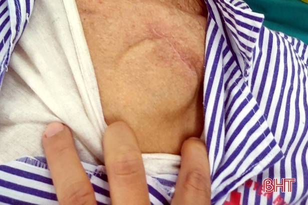 Bệnh viện miền núi phẫu thuật thành công thoát vị bẹn cho bệnh nhân đặt máy tạo nhịp tim