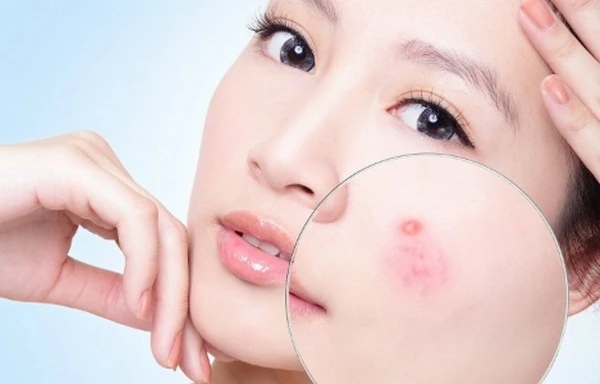 bo tui 5 meo nho de dang danh bay mun giup guong mat luon rang ro