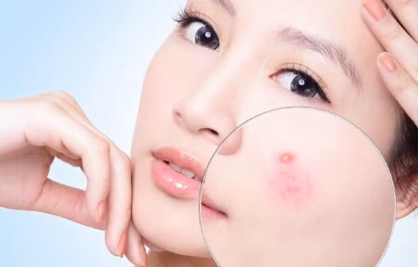 bo tui 5 meo nho de dang danh bay mun giup guong mat luon rang ro