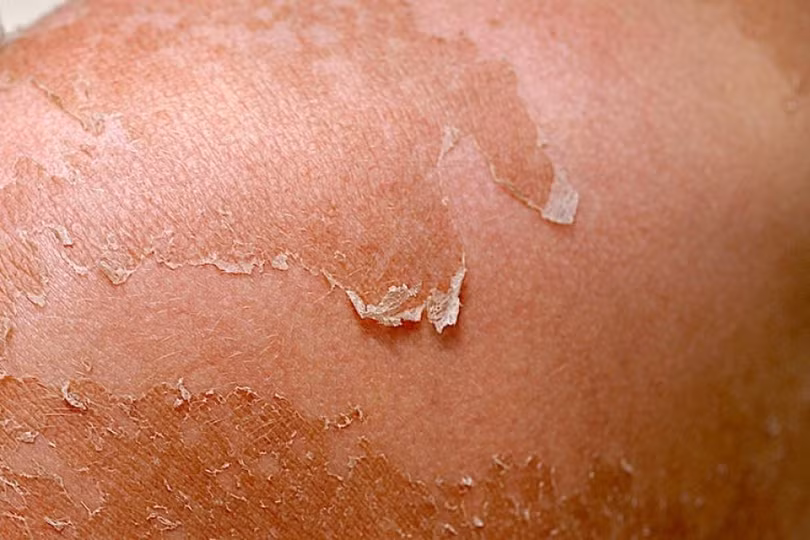 Mách bạn cách điều trị bong tróc da do cháy nắng