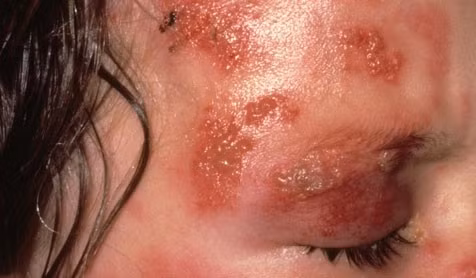 Zona tại vùng mắt có thể gây mù nếu không chữa trị kịp thời. Ảnh: Boldsky