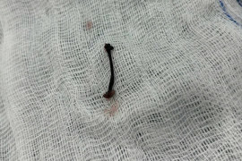 Con vắt sống một tuần trong mũi bé trai 30 tháng tuổi