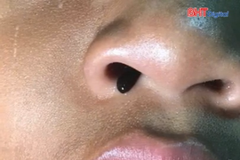 Ho ra máu một tuần, bé trai được phát hiện đỉa trong mũi