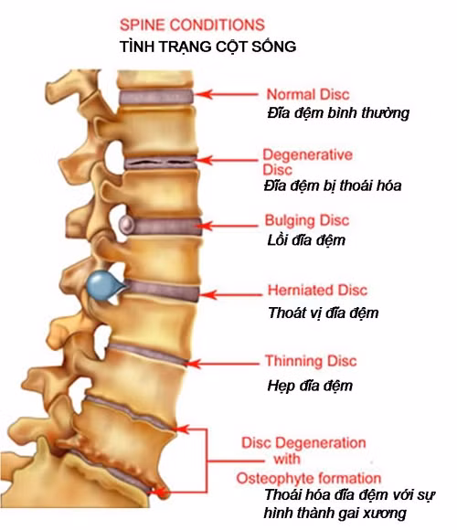 Phó GĐ BV Việt Đức khám, phẫu thuật các bệnh về cột sống tại Hà Tĩnh ảnh 1