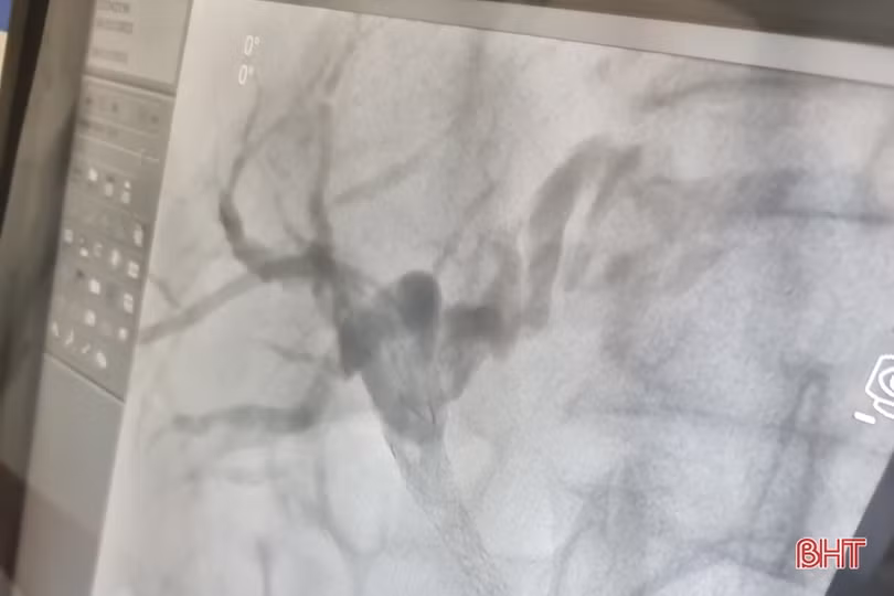BVĐK tỉnh Hà Tĩnh phối hợp thực hiện thành công kỹ thuật đặt stent đường mật