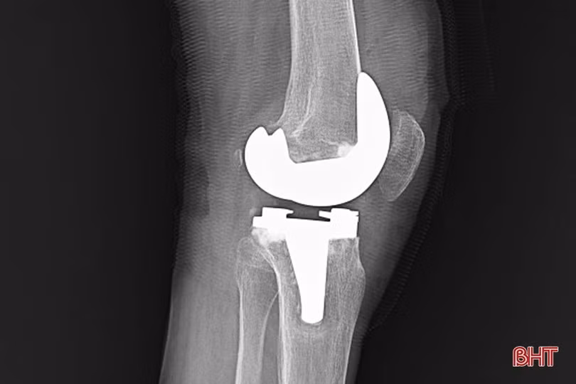 BVĐK tỉnh Hà Tĩnh làm chủ nhiều kỹ thuật chuyên sâu trong chấn thương, chỉnh hình