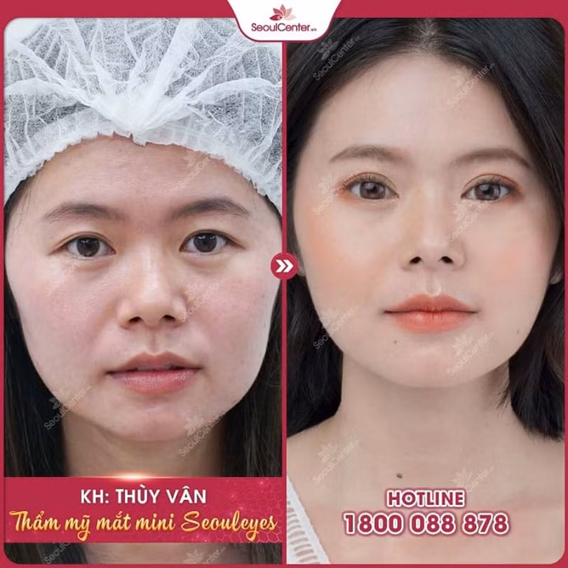 Da mí bị chùng nhão ở phụ nữ có đáng lo ngại? Cách khắc phục