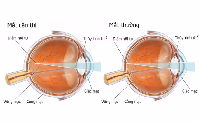 Những lưu ý quan trọng khi sử dụng kính áp tròng
