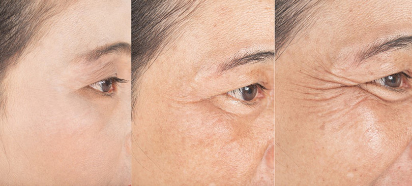 Làn da dần bị thâm nám nếu không được chăm sóc đúng cách giảm nám 2.jpg