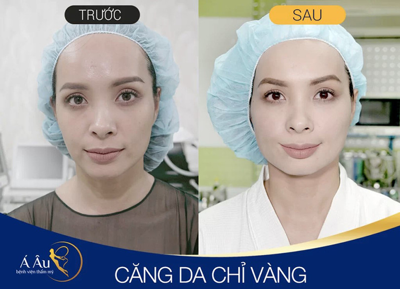Căng da 3.jpg