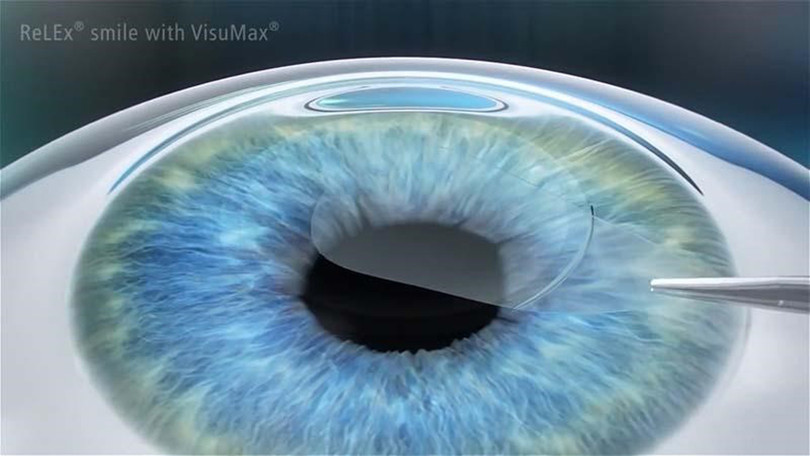 Phẫu thuật ReLEx Smile là phương pháp phẫu thuật xóa cận tiên tiến nhất phẫu thuật 1.jpg