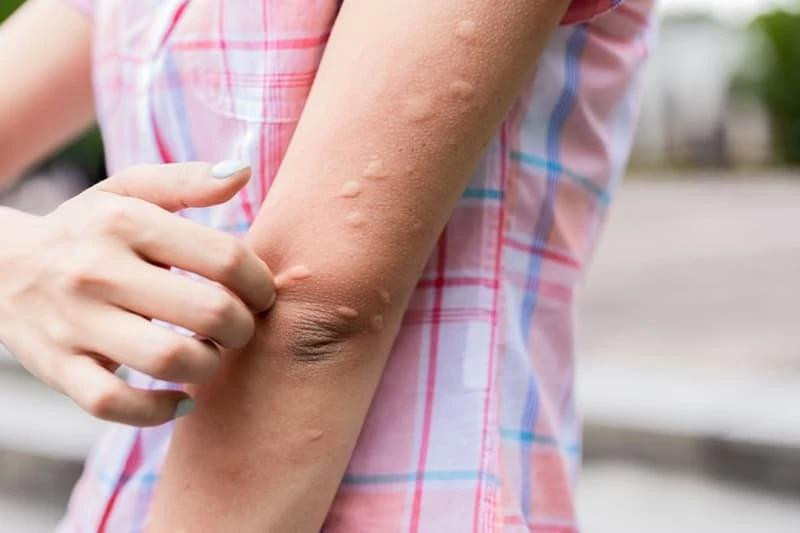 Người tiết ra chất pheromone hấp dẫn được muỗi thì sẽ thu hút muỗi hơn. Ảnh: Drbenmedical. Người tiết ra chất pheromone hấp dẫn được muỗi thì sẽ thu hút muỗi hơn. Ảnh: Drbenmedical.