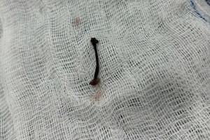 Con vắt sống một tuần trong mũi bé trai 30 tháng tuổi