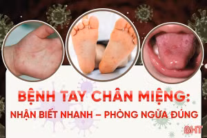 [Infographic] Bệnh tay chân miệng - nhận biết nhanh, phòng ngừa đúng