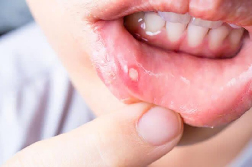 Nhiệt miệng là những vết loét xuất hiện trong khoang miệng gây đau đớn khi ăn uống, giao tiếp nhiet-mieng-1.jpg