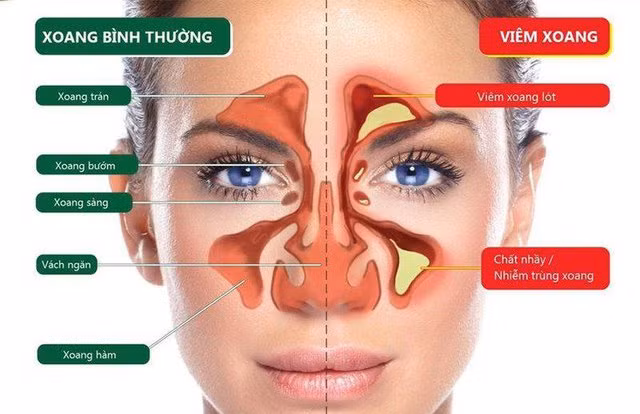 Mùa mưa bị viêm mũi xoang tái phát cần phải làm gì?