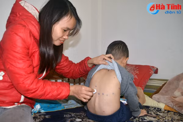 benh thuy dau co xu huong lay lan nhanh phong tru the nao