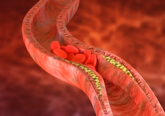 Cholesterol, mỡ máu cao gây bệnh gì?
