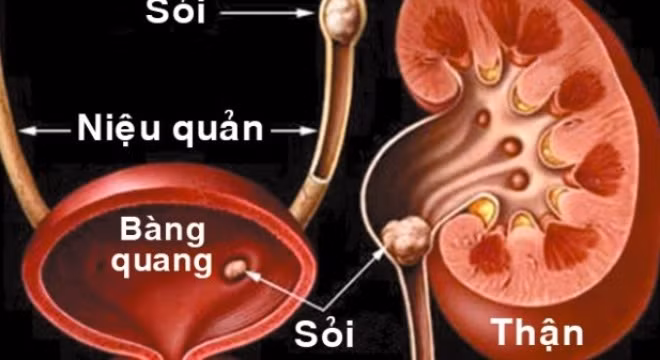 nho uong nhieu nuoc ngua soi than