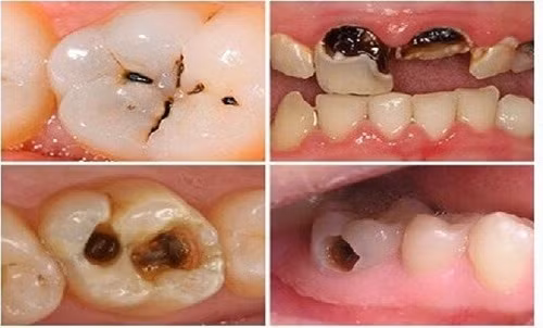Thủ phạm ít được để ý nhưng nguy cơ cao gây đột quỵ não