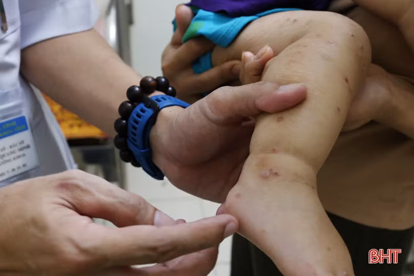Không chủ quan trước diễn biến phức tạp của bệnh tay chân miệng