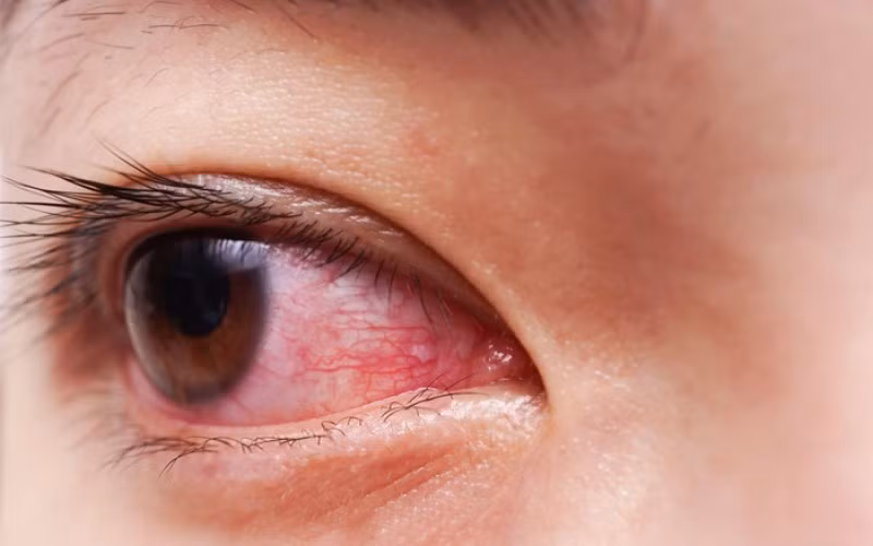 Mùa hè là thời điểm gia tăng các bệnh về mắt.