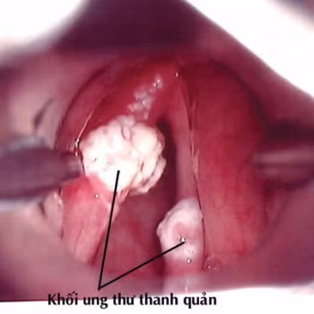 Khàn tiếng - Coi chừng bệnh lý ác tính!