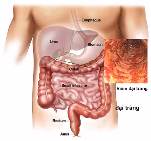 5 dau hieu giup tu nhan biet som ung thu dai truc trang