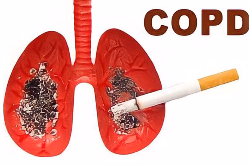 Gần 90% bệnh nhân bị bệnh phổi tắc nghẽn mãn tính có tiền sử liên quan đến thuốc lá