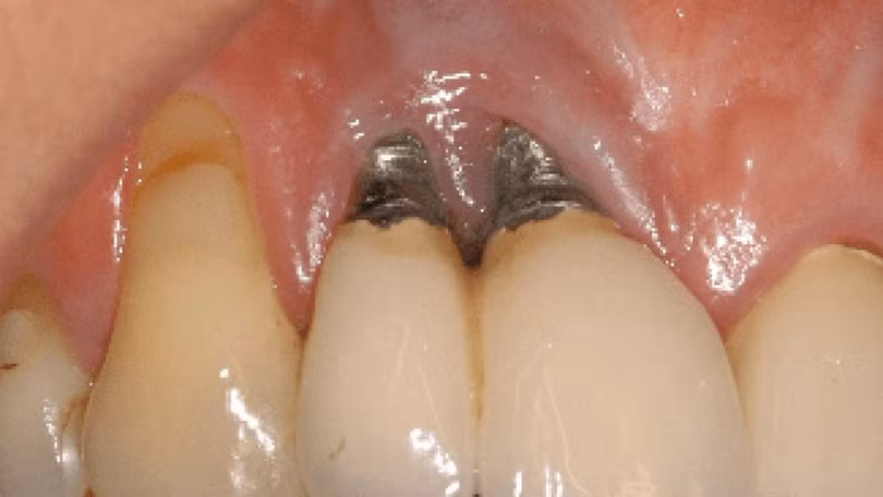 cay-implant-3.jpg