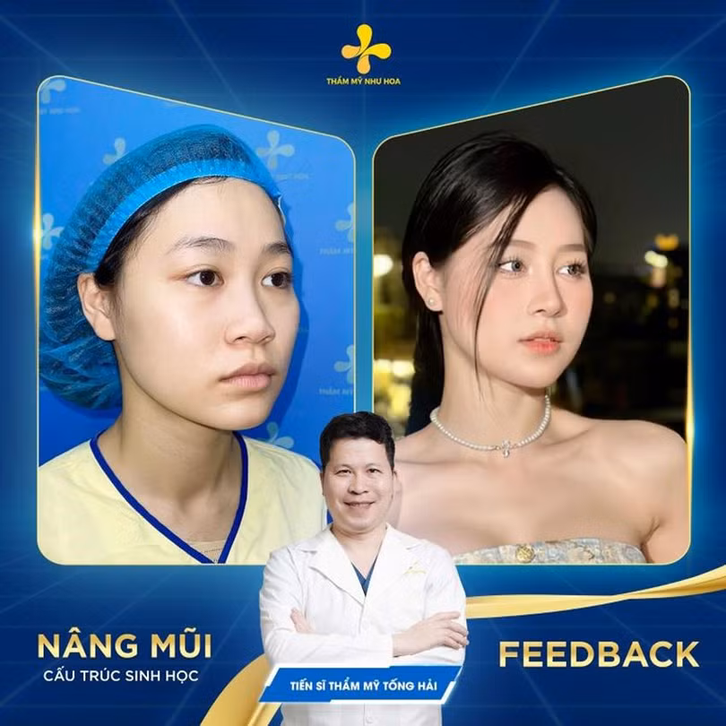 Nâng mũi 4.jpg