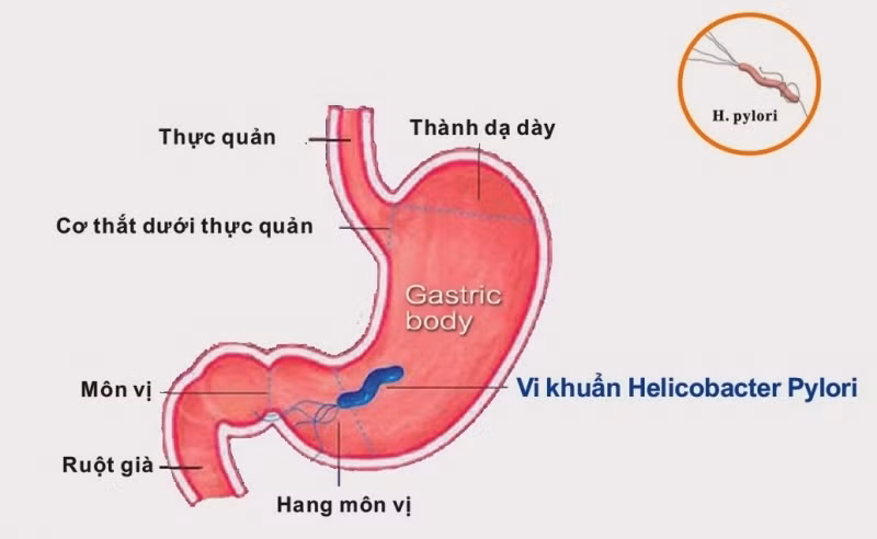 Top 10 bệnh có dấu hiệu nôn ra máu