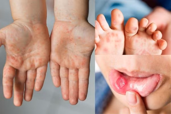 Khẩn: Đã có 5.545 ca tay chân miệng, Bộ Y tế dự báo dịch có thể gia tăng