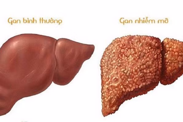 Gan nhiễm mỡ có nguy hiểm không nếu trẻ em mắc phải?