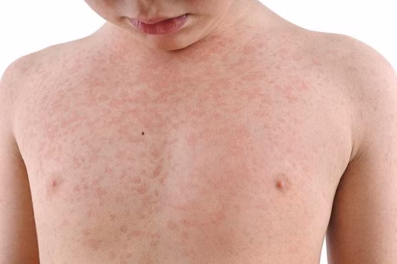 Triệu chứng phát ban ở bệnh nhân sởi