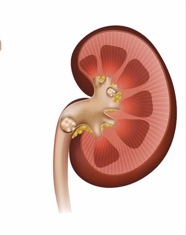 Muối và các bệnh mạn tính liên quan đến huyết áp
