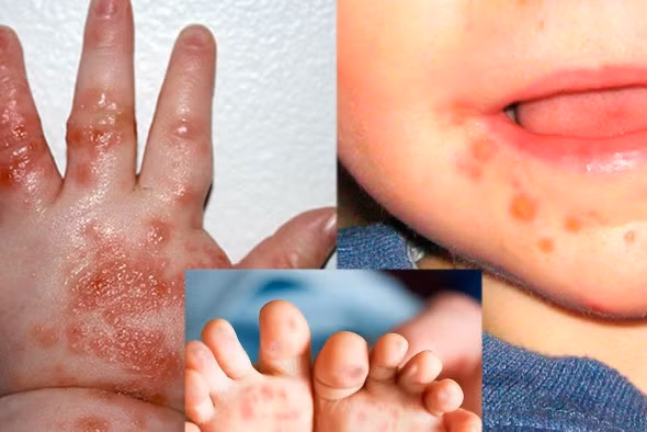 Số mắc tay chân miệng tăng 4 lần, Bộ Y tế yêu cầu phòng chống khẩn
