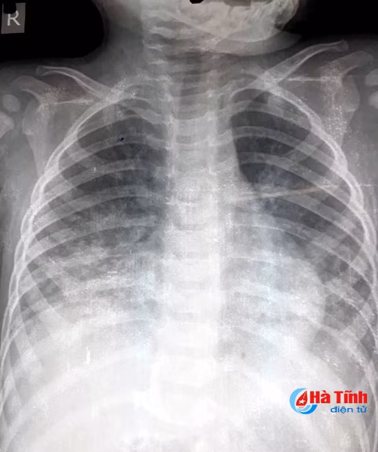 uong nham dau hoa tre 17 thang tuoi viem phoi nang