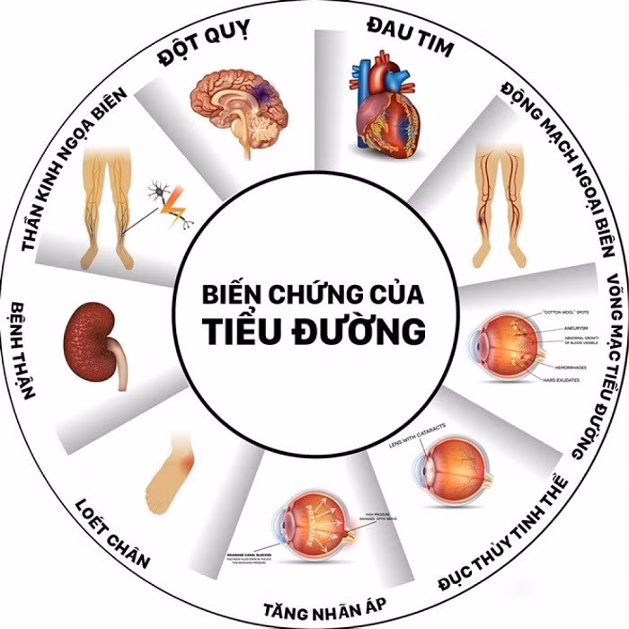 F0 khỏi COVID-19 có nhiều nguy cơ mắc tiểu đường tuýp 2