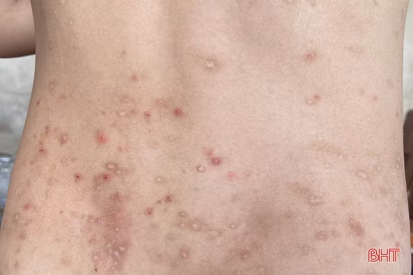 Hà Tĩnh: Tìm ra nguyên nhân bước đầu khiến nhiều người bị viêm da dị ứng do côn trùng đốt