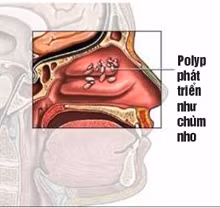 khac phuc chung nghet mui khi chuyen mua