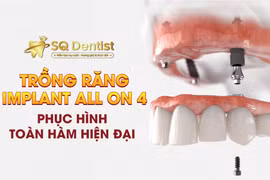 Tiêu xương hàm nặng vẫn trồng được răng nguyên hàm nhờ phương pháp All-on-4