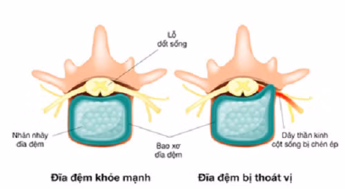 dau hieu canh bao ban bi benh thoat vi dia dem
