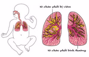 phong benh ho hap khi chuyen mua