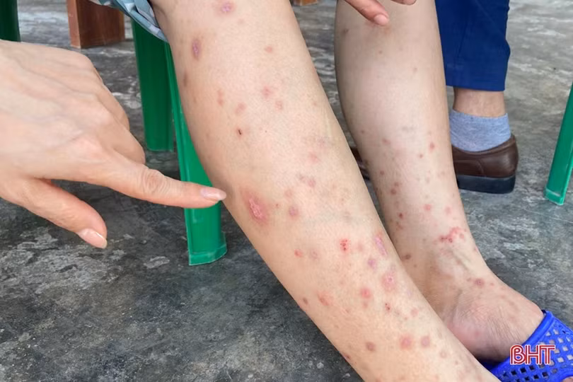 Bác sỹ CDC Hà Tĩnh khuyến cáo những nguy hiểm do bọ chét gây ra