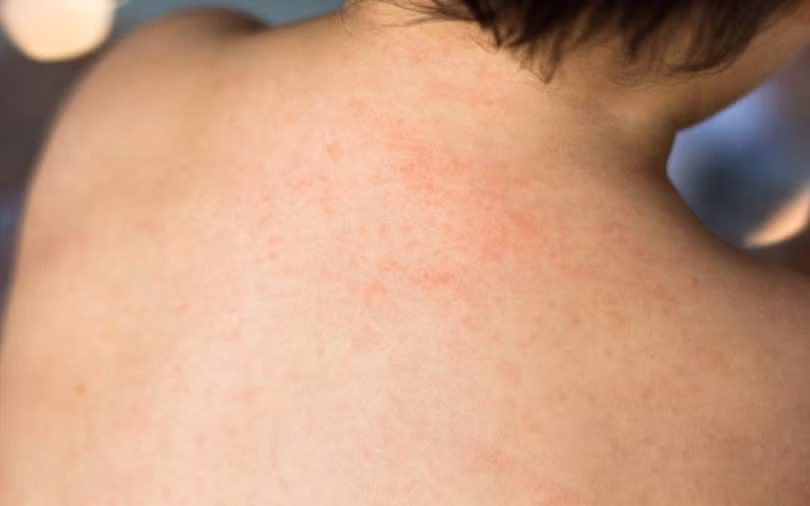 9 bệnh da liễu nguy hiểm ở trẻ