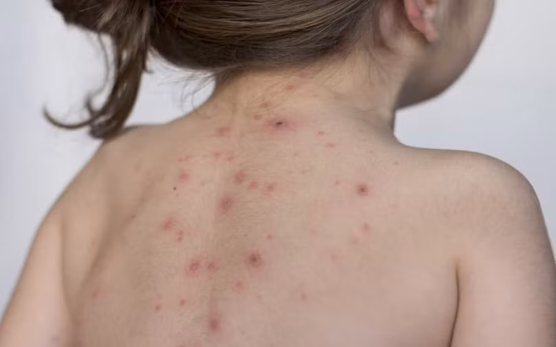 9 bệnh da liễu nguy hiểm ở trẻ